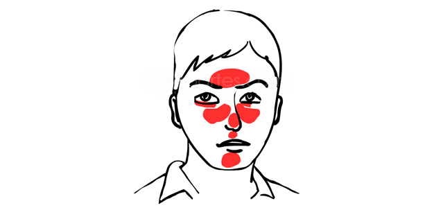 Krankheit Rosacea behandeln